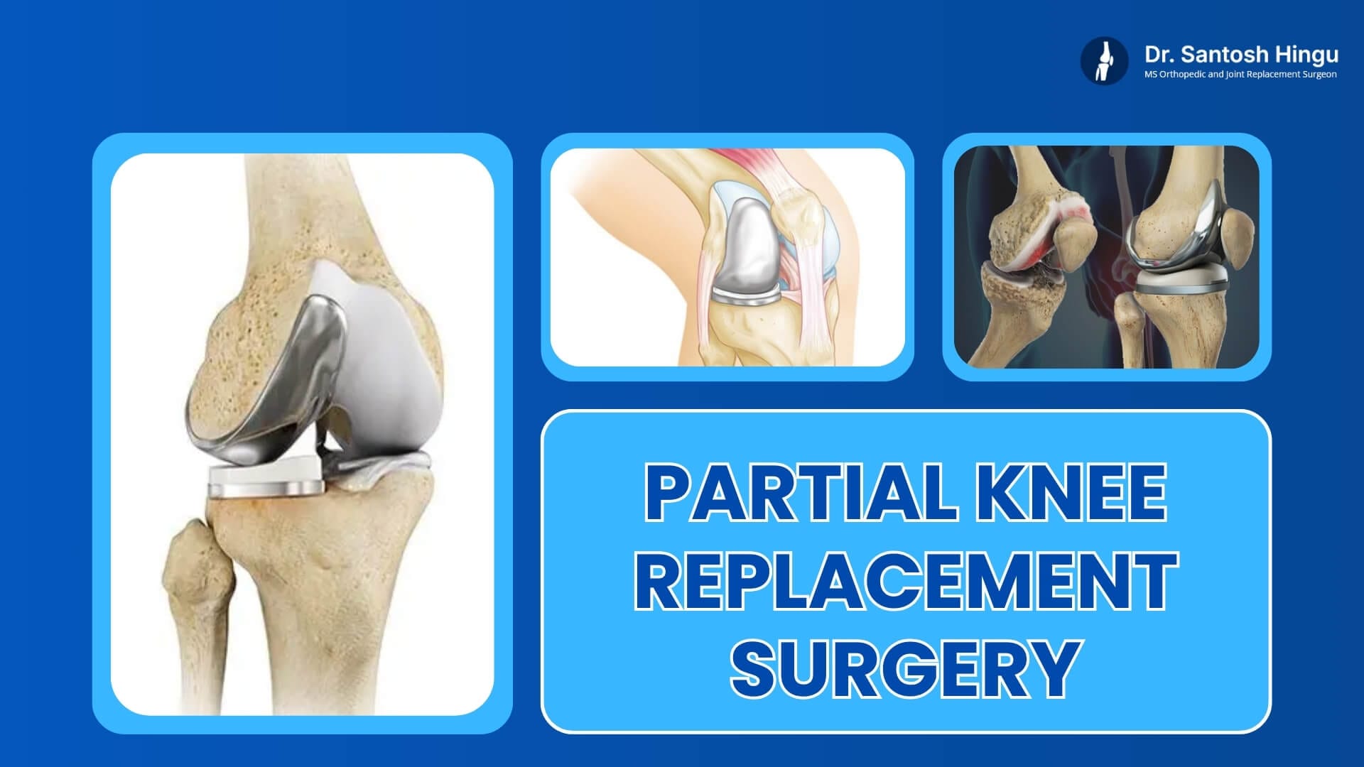 partial knee replacement surgery