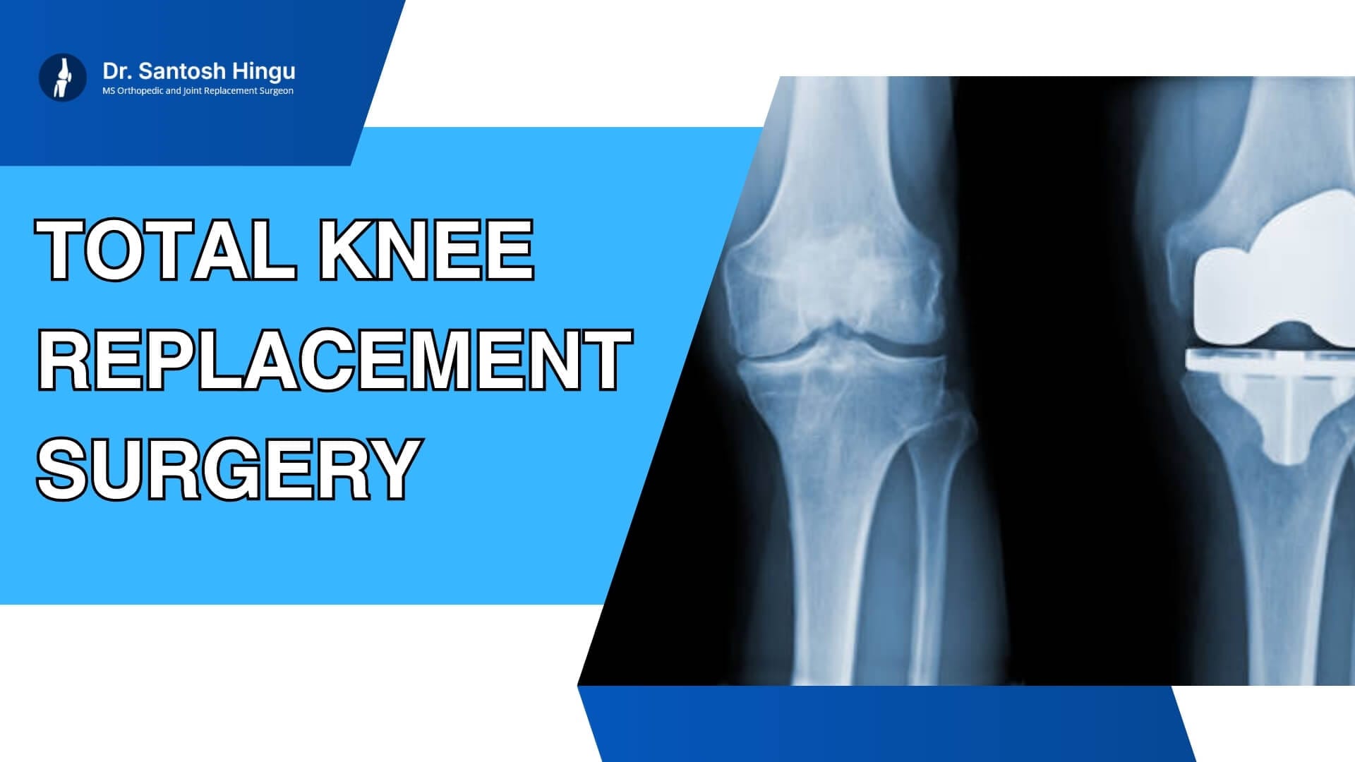 total knee replacement surgery